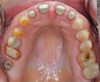 Fig 3. Occlusal view with posts inserted.