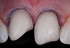 Fig 2. Preoperative (Fig 1), preparation (Fig 2), and final (Fig 3) postoperative images of a two-unit CL-I feldspathic veneer case.