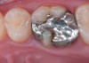 Fig 9. Preoperative view (Fig 9), preparation with composite block-out restoration (Fig 10), and final cementation of CL-IIb material (Fig 11) (final ceramic contour and stain by Steve Lee, CDT, MDC).