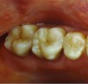 Fig 17. Two-molar full-crown porcelain-fused-to-metal restoration made with a CL-IV substrate