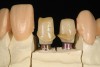 Fig 6. Color of the abutment is matched to adjacent prepared teeth to help blend between implant-supported restorations and natural tooth-supported restorations.