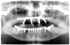 Fig 1. A radiograph of the All-on-4 concept depicting two axially orientated implants in the anterior and two tilted implants in the posterior.