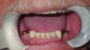 Fig 3. Two implants are placed in the mandible, followed by two healing abutments.