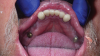 Fig 4. Two implants are placed in the mandible, followed by two healing abutments.