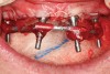 Fig 5. Impression-taking with splinted impression copings with autopolymerizing resin and wire.