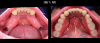 Fig 23. On the day of insertion, the telescoping abutments are placed and torqued to 30 NcM.