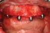 Fig 4. Placement of implants with straight multi-unit abutments on anterior implants and 30-degree angulated abutments posteriorly.