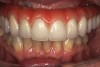 Fig 9. Intraoral view of the titanium bridge framework with individual lithium-disilicate crowns.