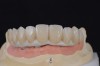 Fig 10. The full-arch zirconia framework with individual lithium-disilicate crowns, which were individually luted in the laboratory.