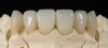 Fig 11. Thin facial layering provides translucency, while full lingual contour zirconia provides durability.