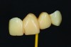 Fig 8. Ovate pontic design tooth No. 10, frontal view.