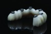 Fig 15. Full-arch implant-supported dental prosthesis with concave tissue surface on the pontics.