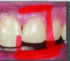 Fig 15. Demonstrating the area masked prior to digital morphing of tooth No. 9.