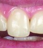 Fig 33. Transform tooth No. 8.