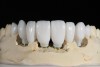 Fig 17. Zirconia abutments with PMMA provisional restorations designed with 3Shape software.