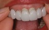 Fig 2. The patient placed the removable Trial Smile restoration in her mouth.