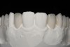 Fig 9. Four additional no-preparation monolithic lithium disilicate veneers were created for teeth No 4, No. 5, No. 12, and No. 13, along with a partial monolithic veneer for tooth No. 6.