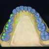 Fig 4 and Fig 5. The cusps indicated with green are molding cusps, while those with red dots are cutting cusps.