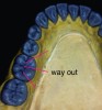 Fig 7. Non-working grooves offer the exit route during mastication with the upper cusps.