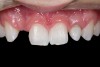Fig 2. After orthodontic alignment of teeth and bleaching. Note alveolar deficiency in right lateral incisor site and diminutive left lateral incisor.
