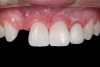 Fig 3. After resin-based composite bonding of the three incisors.