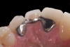 Fig 5. Double-wing metal resin-bonded bridge replacing lateral incisor (lingual view).