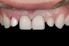 Fig 9. Veneer preparations of incisors and zirconia abutment of right lateral incisor, 13 days after exposure of implant head (second stage surgery).