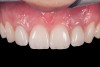 Fig 10. Implant crown and incisor veneers 14 days after exposure of implant.