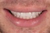 Fig 11. Smile view, 14 days after exposure of implant.