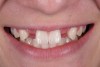 Fig 12. 15-year-old girl after orthodontic therapy idealized maxillary lateral incisor spaces.