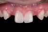 Fig 13. Deficient ridges in the areas of the missing lateral incisors.
