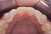 Fig 24. Occlusal view.