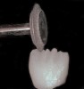 Fig 2. A contoured diamond wheel can be used to shape mamelons on a hot-pressed leucite-reinforced ceramic crown.