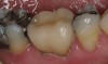 Fig 11. Postoperative view. Before the crown was cemented, it had been placed in a ceramic oven that reached a temperature of 850°C. At this temperature, crystallization of the ceramic occurs, resulting in a change of lithium metasilicate to disilicate.