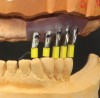 Fig 2. Properly designed surgical guides can lead to proper implant placement.