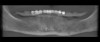 Figure 13. Panoramic image rendered from CBCT cross sections in a patient with mucosa-supported radiographic guide.