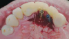 Fig 10. Try-in of the existing teeth-supported provisional prosthesis and screw-retained titanium abutments is shown. Adjacent prepared teeth (Nos. 8 and 11) are used as a stop to pick up the abutments accurately. (Surgery performed by Andrew Andrawis, DDS, and prosthetic procedures performed by the author.)