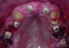 Fig 15. The provisional abutments after preparation and sealing of access holes. The implants in this case are not loaded immediately. Remaining teeth are extracted at a later appointment. <br>