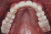 Fig 17. The provisional prosthesis is relined with PMMA and then the palatal stop or acrylic resin support is removed.