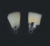 Fig 23. Provisional prosthesis (left) and definitive prosthesis (right) are complete. (Final crown fabricated by Bill Baum, CDT.)