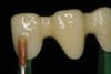 Fig 18. A coat of shade base stain is applied to the zirconia substructure and fired before applying the veneering porcelain.
