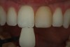 Fig 7. A shade photo using dual polarization. (Photos courtesy of Joseph Fusco, DDS)