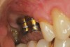 Fig 1. Two stock abutments have been modified with apical and coronal circumferential undercuts.