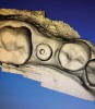 Fig 2. The scanned image of the abutment shows the clearly defined screw-access hole.