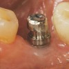 Fig 3. The titanium carrier fixture has been modified for sufficient occlusal and interproximal clearance.