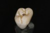 Fig 5. Thinned brown stain is applied to the occlusal surface.