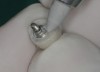 Fig 8. The tissue side of the implant-supported crown can be refined and polished.