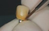 Fig 9. After the staining is completed, the implant crown can be inserted and torqued to the manufacturer’s recommendation.