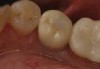 Fig 10. Lingual view of the screw-retained implant crown after placement of the composite “patch,” smoothing, and polishing.