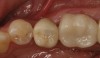 Fig 12. Occlusal view of the screw-retained implant crown.